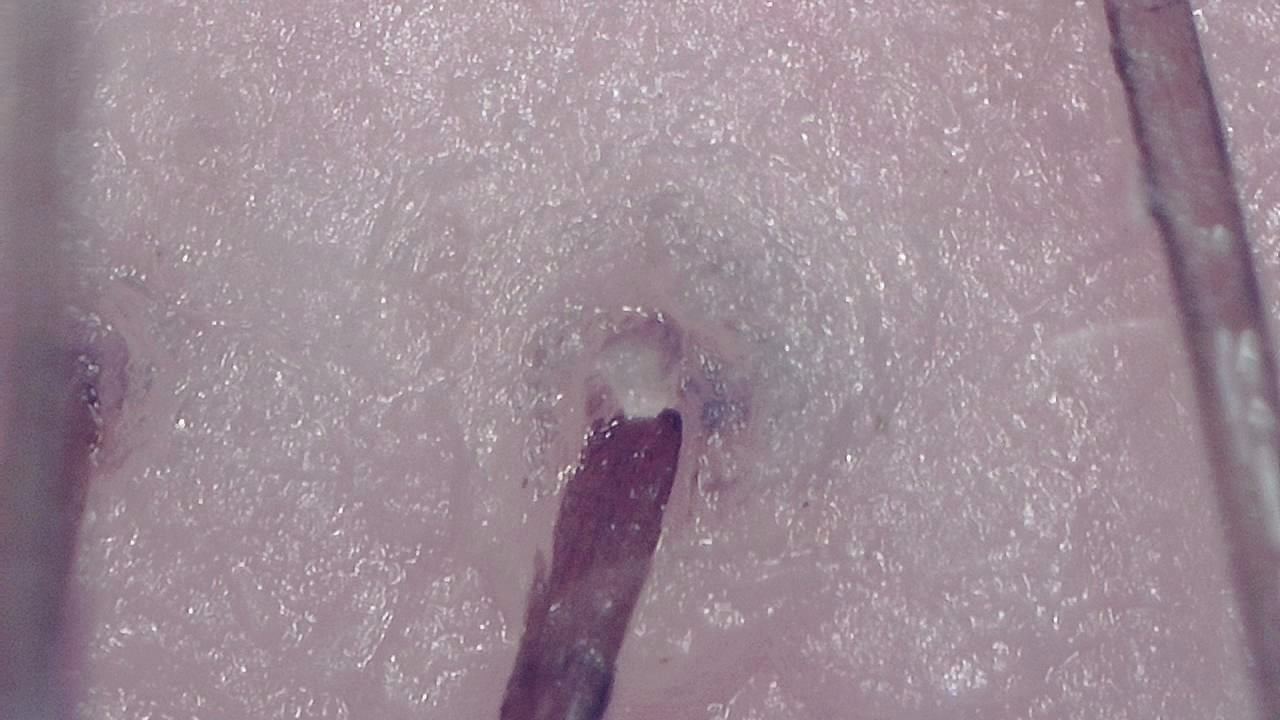 毛髪と頭皮のトリコスコープ検査 顕微鏡画像の例 1