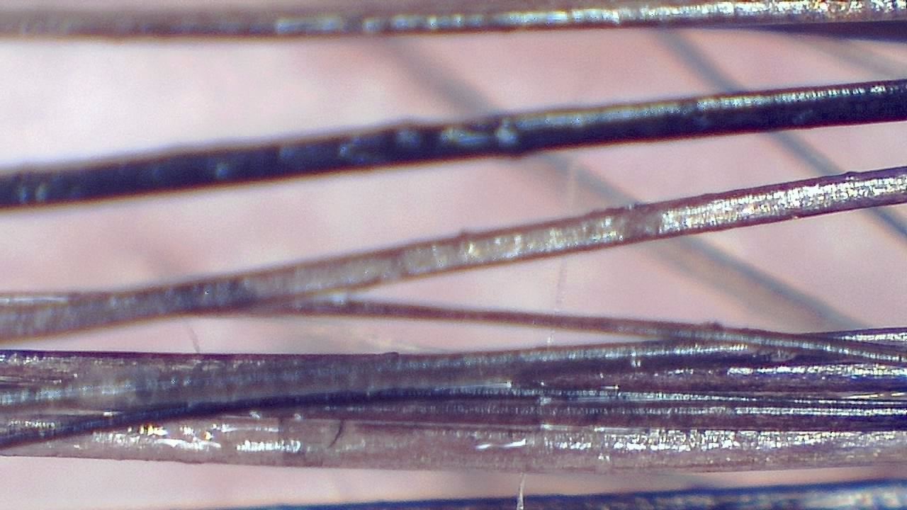 毛髪と頭皮のトリコスコープ検査 顕微鏡画像の例 5