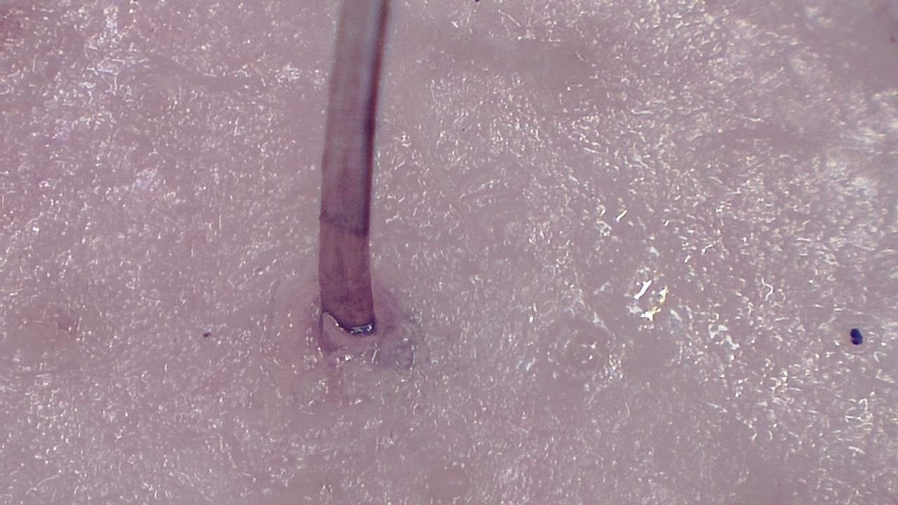 毛髪と頭皮のトリコスコープ検査 顕微鏡画像の例 7