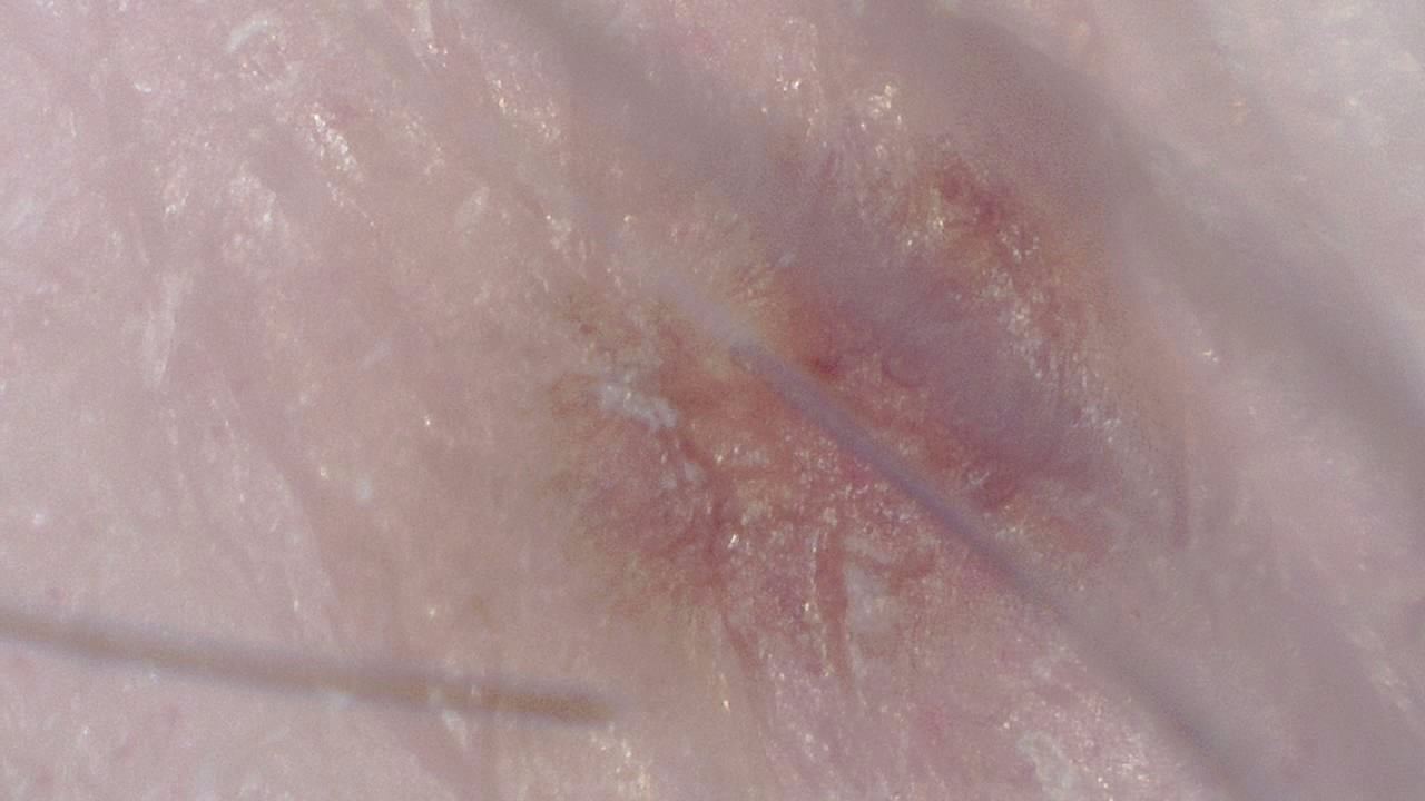 臨床皮膚科 顕微鏡画像の例 2