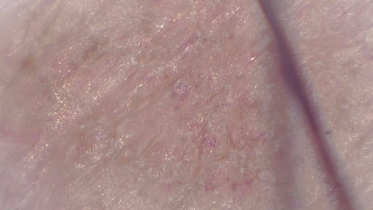 臨床皮膚科 顕微鏡画像の例 3