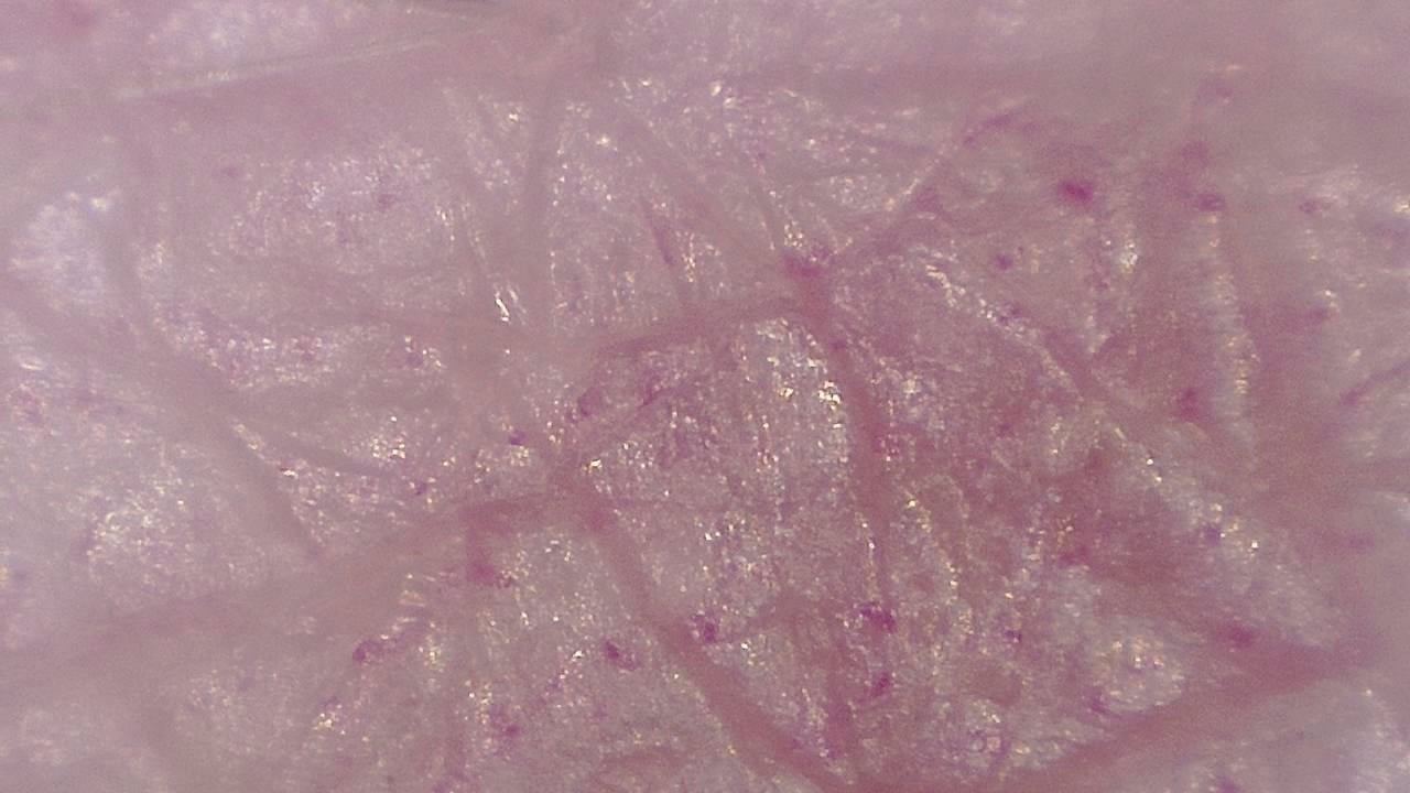 臨床皮膚科 顕微鏡画像の例 5