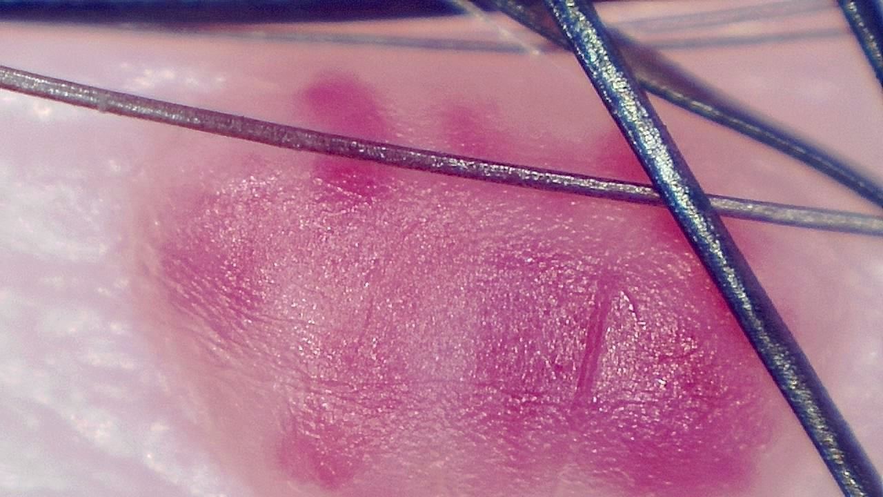 臨床皮膚科 顕微鏡画像の例 6